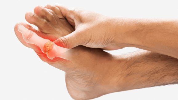 Uric Acid Symptoms: ఈ లక్షణాలు కనిపిస్తే మీ బాడీలో యూరిక్ యాసిడ్ విపరీతంగా పెరిగిపోయిందని అర్థం Uric Acid Symptoms: ఈ లక్షణాలు కనిపిస్తే మీ బాడీలో యూరిక్ యాసిడ్ విపరీతంగా పెరిగిపోయిందని అర్థం