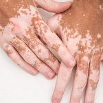 foods for Vitiligo: ఈ ఐదు రకాల ఆహారాలు తిన్నారంటే బొల్లి మచ్చలు మరింత పెరిగిపోతాయి, జాగ్రత్త