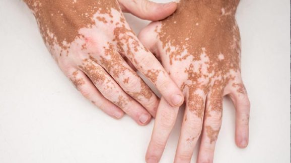 foods for Vitiligo: ఈ ఐదు రకాల ఆహారాలు తిన్నారంటే బొల్లి మచ్చలు మరింత పెరిగిపోతాయి, జాగ్రత్త