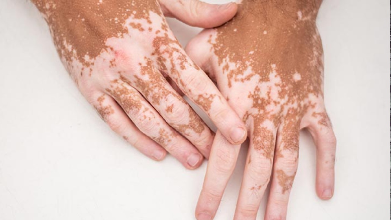 foods for Vitiligo: ఈ ఐదు రకాల ఆహారాలు తిన్నారంటే బొల్లి మచ్చలు మరింత పెరిగిపోతాయి, జాగ్రత్త