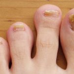 Nail Fungus: గోళ్లపై ఫంగస్.. ఈ ఇన్ఫెక్షన్‌కు కారణాలేంటి ?