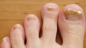 Nail Fungus: గోళ్లపై ఫంగస్.. ఈ ఇన్ఫెక్షన్‌కు కారణాలేంటి ?