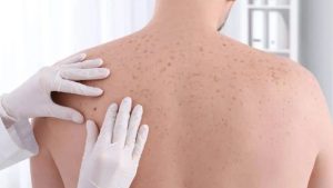 Skin Cancer: గాయాలు త్వరగా నయం కావడం లేదా ? ఇదే కారణం కావొచ్చు !