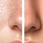 Open Pores On Face: ఓపెన్ పోర్స్ సమస్యతో ఇబ్బంది పడుతున్నారా ?