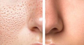 Open Pores On Face: ఓపెన్ పోర్స్ సమస్యతో ఇబ్బంది పడుతున్నారా ?