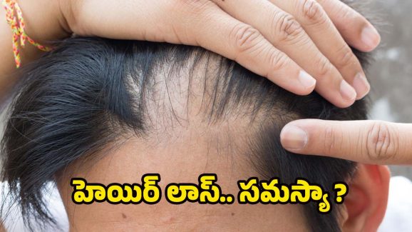 Hair Loss: ఈ విటమిన్ లోపమే.. జుట్టు రాలడానికి కారణమట !