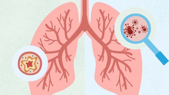 Pneumonia causes: న్యుమోనియా రావడానికి అసలు కారణాలివే !