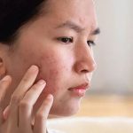 Pimples: ఈ ఒక్క ఫేస్ ప్యాక్ వాడితే.. ముఖంపై మొటిమలు మాయం !