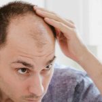 Bald head: పురుషుల్లో బట్టతల రావడానికి.. అసలు కారణాలివేనట !