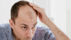 Bald head: పురుషుల్లో బట్టతల రావడానికి.. అసలు కారణాలివేనట !