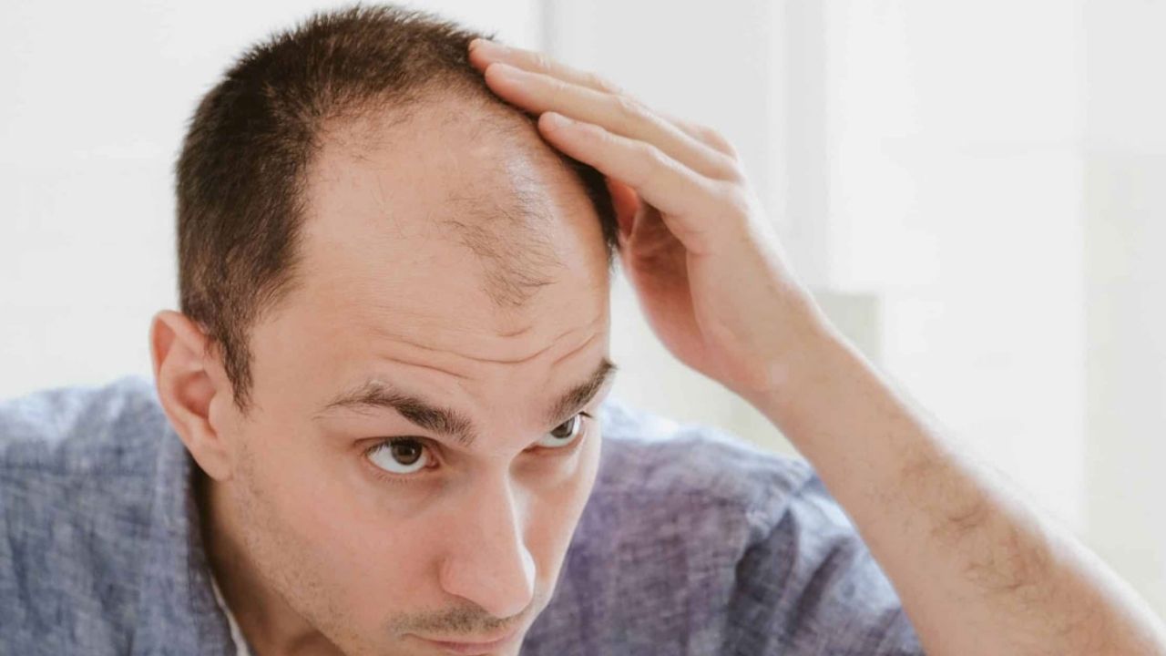 Bald head: పురుషుల్లో బట్టతల రావడానికి.. అసలు కారణాలివేనట !