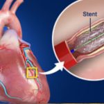 Heart Stent: గుండెకు స్టంట్ ఎందుకు వేస్తారు? తర్వాత తీసుకోవాల్సిన జాగ్రత్తలేంటి ?