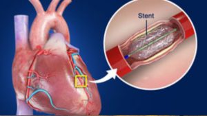Heart Stent: గుండెకు స్టంట్ ఎందుకు వేస్తారు? తర్వాత తీసుకోవాల్సిన జాగ్రత్తలేంటి ?