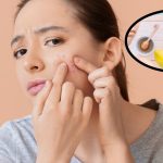 Get Rid of Pimples: మొటిమలు త్వరగా తగ్గాలంటే ?