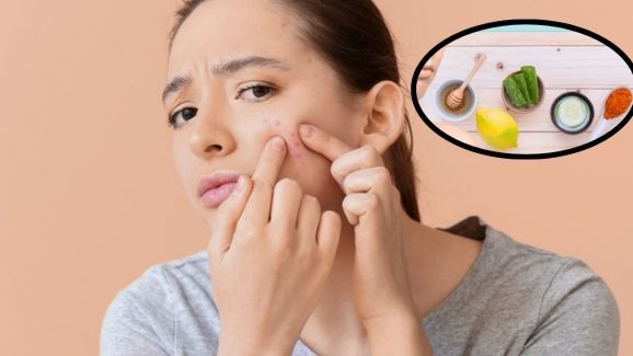 Get Rid of Pimples: మొటిమలు త్వరగా తగ్గాలంటే ?
