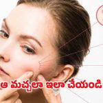 Dark Spots: ముఖం పై నల్ల మచ్చలు.. ఇలా చేస్తే చిటికెలో మాయం