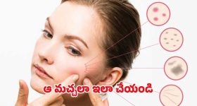 Dark Spots: ముఖం పై నల్ల మచ్చలు.. ఇలా చేస్తే చిటికెలో మాయం