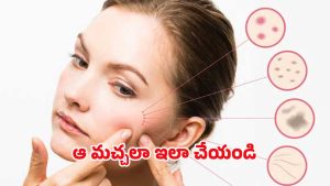 Dark Spots: ముఖం పై నల్ల మచ్చలు.. ఇలా చేస్తే చిటికెలో మాయం