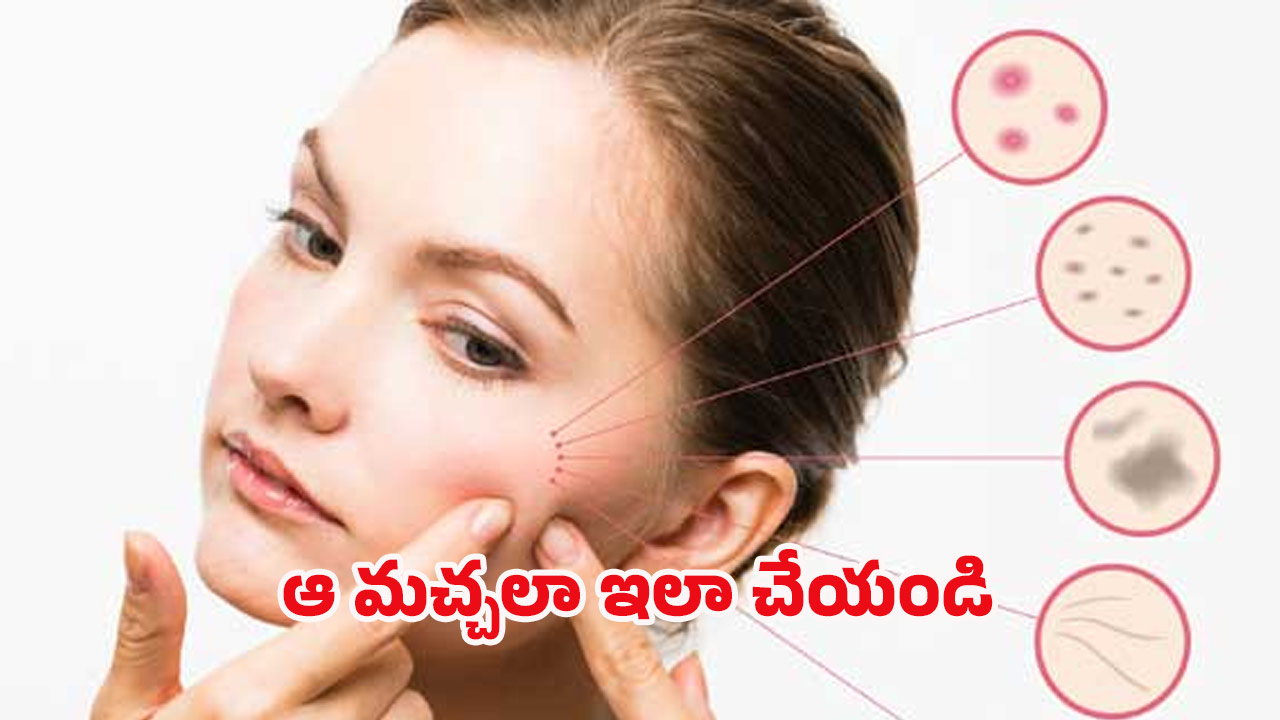 Dark Spots: ముఖం పై నల్ల మచ్చలు.. ఇలా చేస్తే చిటికెలో మాయం