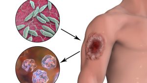 Flesh Eating Parasite: మనిషి చర్మాన్ని తినేస్తున్న పురుగు.. మీరు అక్కడ ఉంటే జాగ్రత్త బాబోయ్!