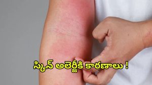 Skin Allergy: స్కిన్ అలెర్జీకి కారణాలివేనట !