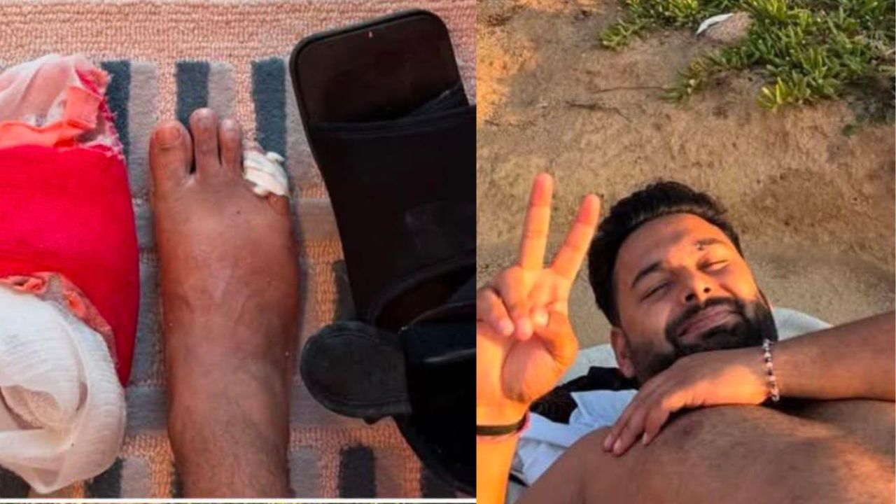 Rishabh Pant : రిషబ్ పంత్ విరిగిన కాలి వేళ్ళు.. ఫోటో వైరల్..