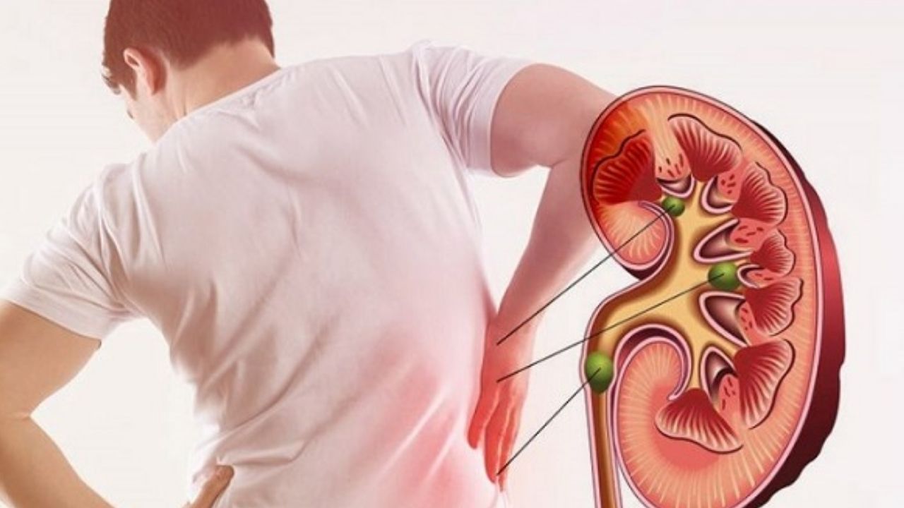 Kidney Stones: కిడ్నీ స్టోన్స్ సమస్యా ? ఇవి తింటే.. ప్రాబ్లమ్ సాల్వ్