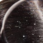 Dandruff: ఈ టిప్స్ పాటిస్తే.. చుండ్రు ఈజీగా తగ్గిపోతుంది తెలుసా ?