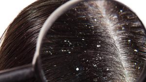 Dandruff: ఈ టిప్స్ పాటిస్తే.. చుండ్రు ఈజీగా తగ్గిపోతుంది తెలుసా ?