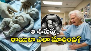 Stone Baby: 82 ఏళ్ల బామ్మ కడుపులో స్టోన్ బేబీ.. వైద్య చరిత్రలో అరుదైన కేసు ఇది!