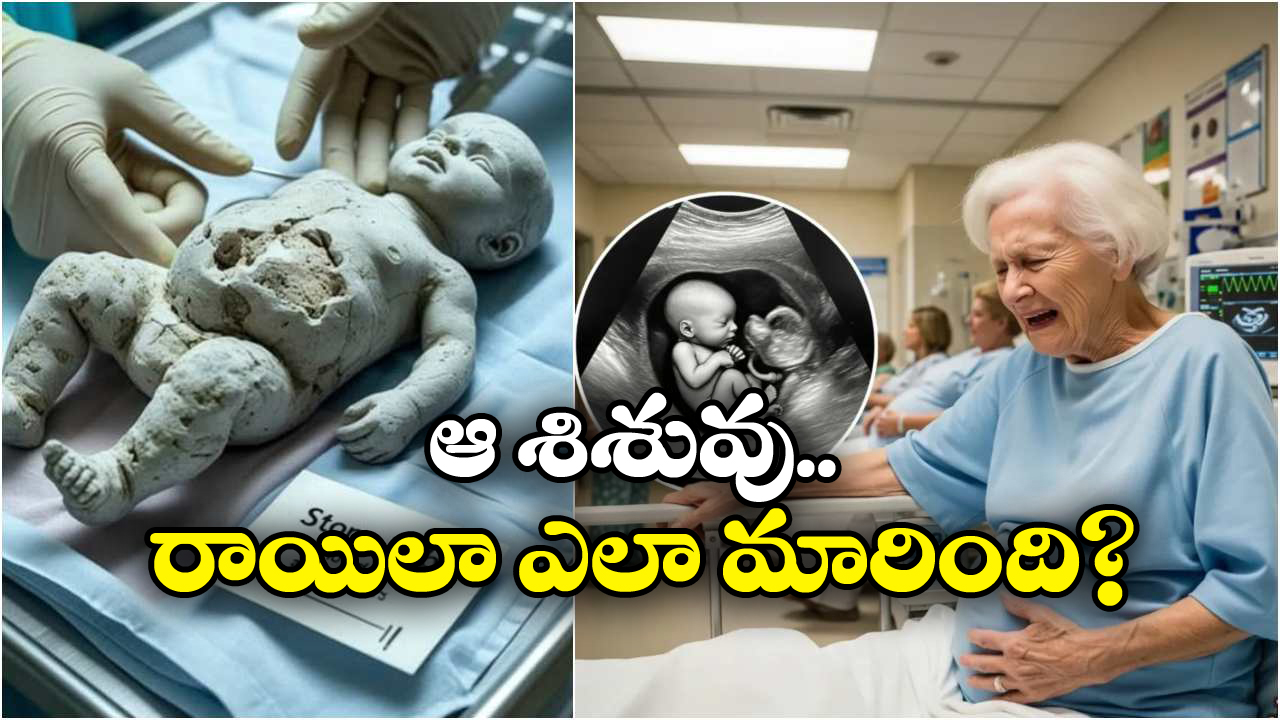 Stone Baby: 82 ఏళ్ల బామ్మ కడుపులో స్టోన్ బేబీ.. వైద్య చరిత్రలో అరుదైన కేసు ఇది!