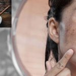 Dark Spots: ముఖంపై నల్ల మచ్చలా ? ఇలా చేస్తే.. ప్రాబ్లమ్ సాల్వ్