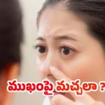 Whiteheads: ముఖంపై తెల్ల మచ్చలా? ఈ టిప్స్ పాటిస్తే సరి !