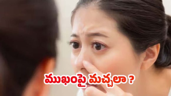 Whiteheads: ముఖంపై తెల్ల మచ్చలా? ఈ టిప్స్ పాటిస్తే సరి !