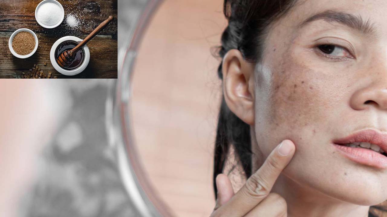 Dark Spots: ముఖంపై నల్ల మచ్చలా ? ఇలా చేస్తే.. ప్రాబ్లమ్ సాల్వ్
