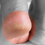 Cracked Heels: పాదాలపై పగుళ్లా ? ఇలా చేస్తే.. ప్రాబ్లమ్ సాల్వ్