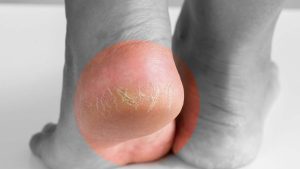 Cracked Heels: పాదాలపై పగుళ్లా ? ఇలా చేస్తే.. ప్రాబ్లమ్ సాల్వ్