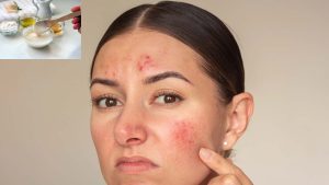 Pimples On Face: మొటిమలతో ఇబ్బంది పడుతున్నారా ? ఇలా చేస్తే ప్రాబ్లమ్ సాల్వ్