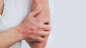 Blood Cancer Symptoms: ఈ లక్షణాలు మీలో ఉన్నాయా ? అస్సలు లైట్ తీసుకోవద్దు, బ్లడ్ క్యాన్సర్ కావొచ్చు