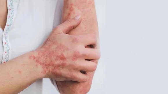 Blood Cancer Symptoms: ఈ లక్షణాలు మీలో ఉన్నాయా ? అస్సలు లైట్ తీసుకోవద్దు, బ్లడ్ క్యాన్సర్ కావొచ్చు Blood Cancer Symptoms: ఈ లక్షణాలు మీలో ఉన్నాయా ? అస్సలు లైట్ తీసుకోవద్దు, బ్లడ్ క్యాన్సర్ కావొచ్చు