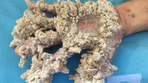 Ichthyosis Vulgaris: ఇదో వింత వ్యాధి, లక్షణాలు గుర్తించకపోతే ప్రాణాలకే ప్రమాదం