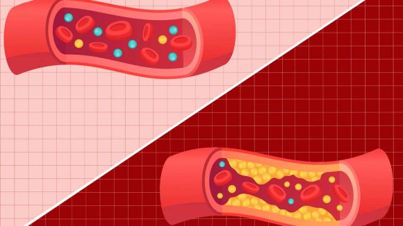 Good Vs Bad Cholesterol: మంచి, చెడు కొలెస్ట్రాల్ మధ్య తేడా ఏంటి ? Good Vs Bad Cholesterol: మంచి, చెడు కొలెస్ట్రాల్ మధ్య తేడా ఏంటి ?