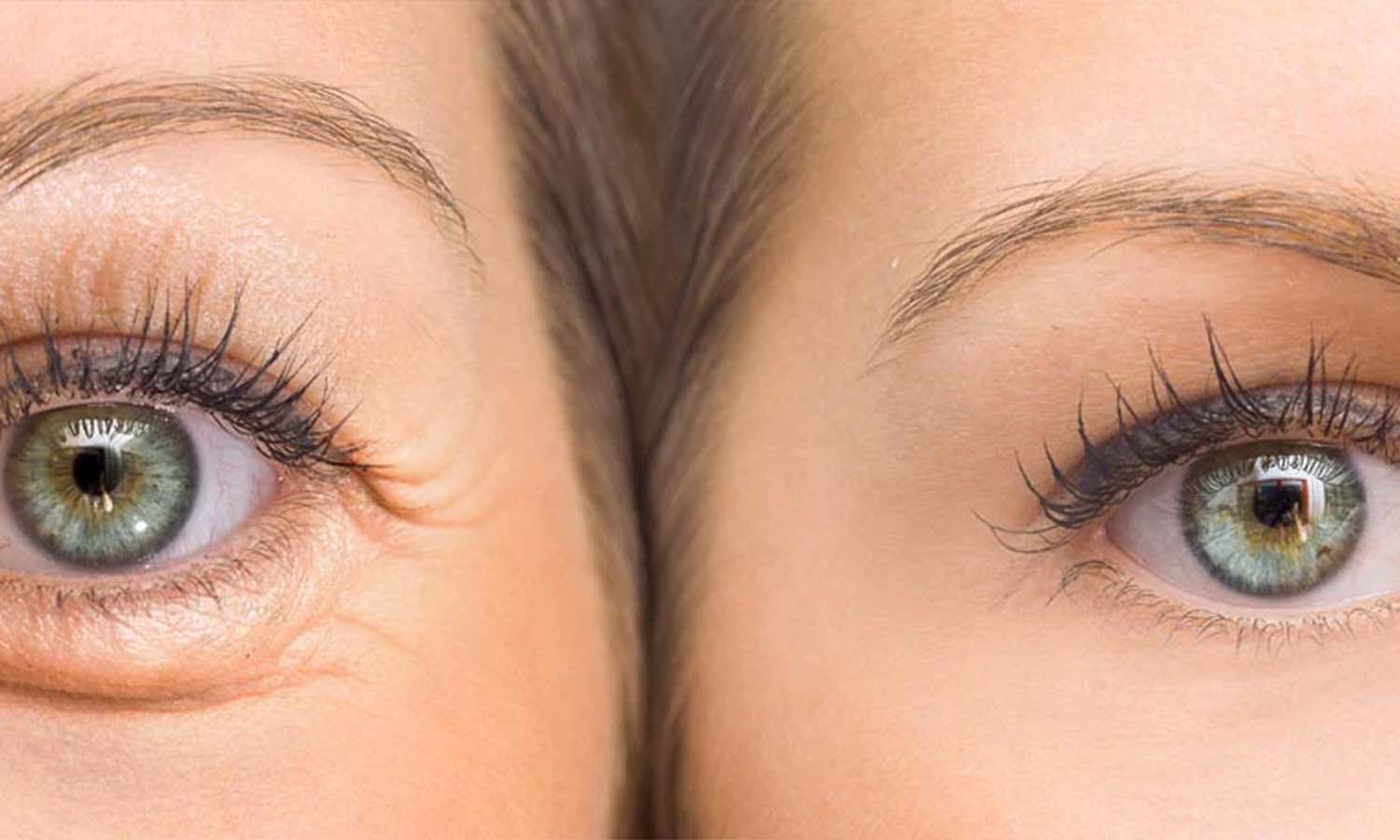 Wrinkles: చిన్న వయస్సులోనే ముఖంపై ముడతలా ?