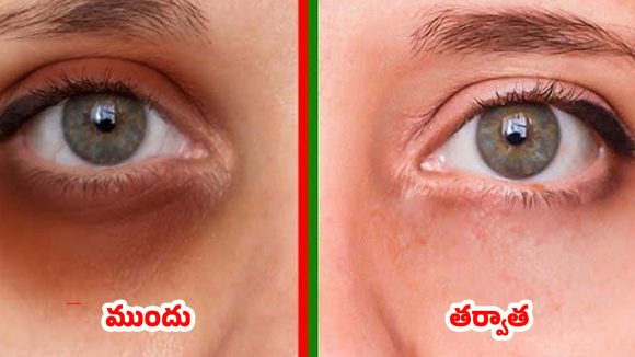 Alum For Dark Circles: పటికతో డార్క్ సర్కిల్స్‌కి చెక్.. ఒక్కసారి వాడితే బోలెడు బెనిఫిట్స్