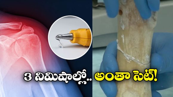 Broken Bone: ఎముక విరిగిందా? ఇక నో టెన్షన్.. జస్ట్ గమ్ పెట్టి అతికించేయడమే!