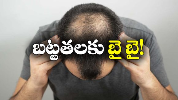 Bald Head: బట్టతల బాబులకు బంగారం లాంటి న్యూస్, ఇలా చేస్తే నేచురల్‌ గానే జుట్టు వచ్చేస్తాదట!