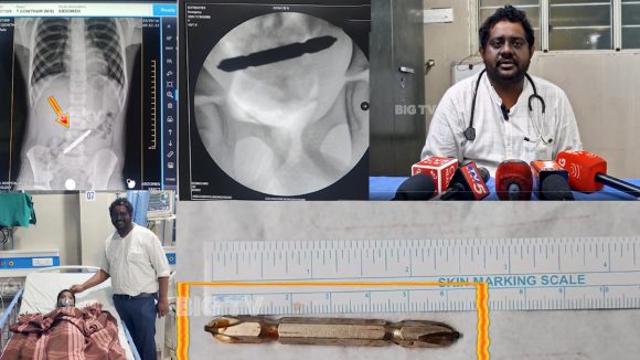 Screwdriver: స్క్రూడ్రైవర్ మింగేసిన 8 ఏళ్ల బాలుడు.. సర్జరీ చేసి వెలికి తీసిన వైద్యులు.