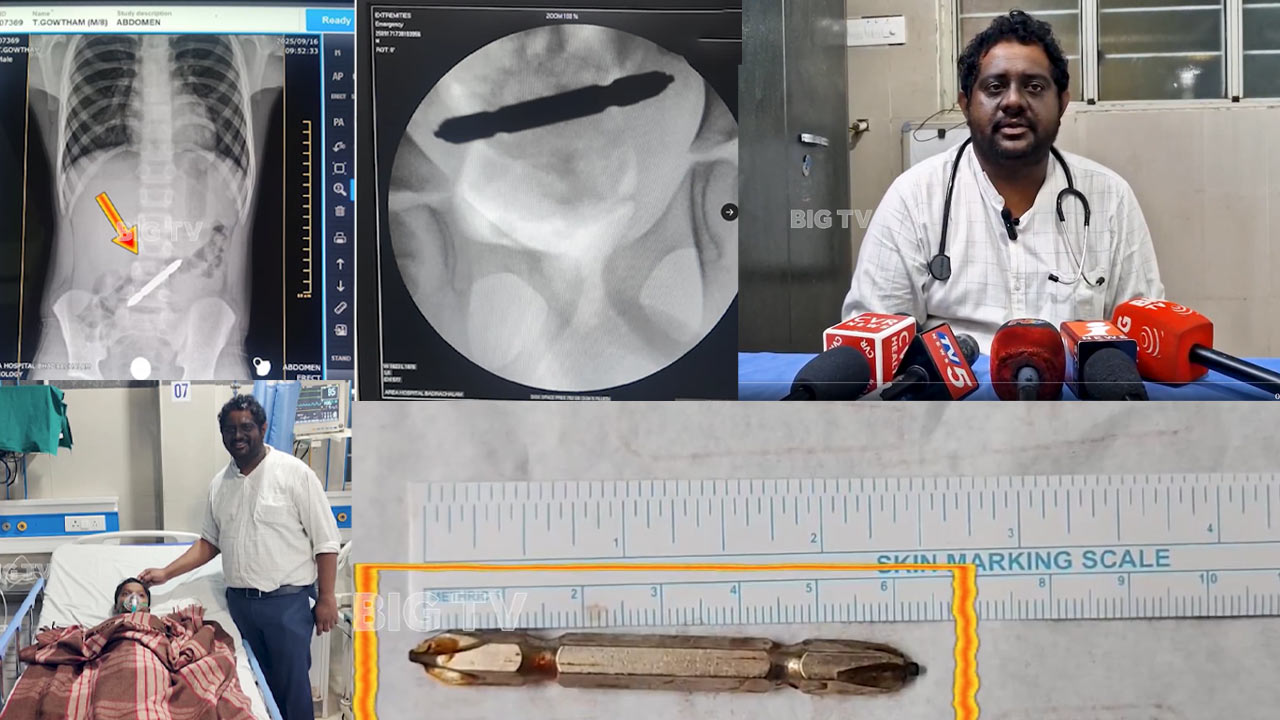 Screwdriver: స్క్రూడ్రైవర్ మింగేసిన 8 ఏళ్ల బాలుడు.. సర్జరీ చేసి వెలికి తీసిన వైద్యులు.