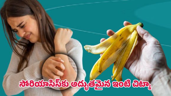 Psoriasis Health Tips: బనానా తొక్కతో సోరియాసిస్ తగ్గుతుందా? నిజం ఏమిటో తెలుసుకోండి