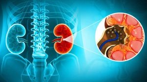 Kidney Stones: ఈ లక్షణాలు మీలో ఉన్నాయా ? అయితే కిడ్నీ స్టోన్స్ కావొచ్చు !